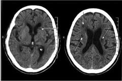 CT上的“烙印”- 腔隙性脑梗死
