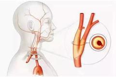 如何正确面对颈动脉斑块？