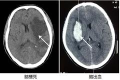 五花八门的脑部影像检查都在看啥？（二）