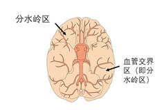 脑部动脉狭窄需要警惕低灌注性脑梗死 